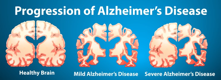 Alzheimer’s disease supplement