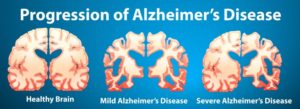 Supplement for Alzheimer’s disease