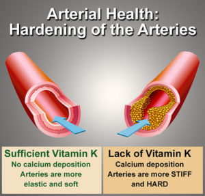 Vitamin K2 vascular calcification